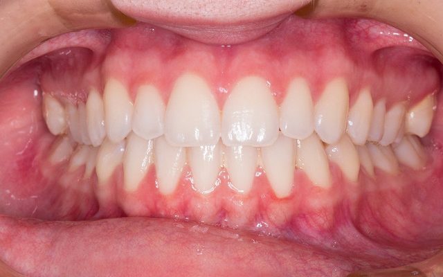 Wyszczerbianie zęba - jak przebiega proces?