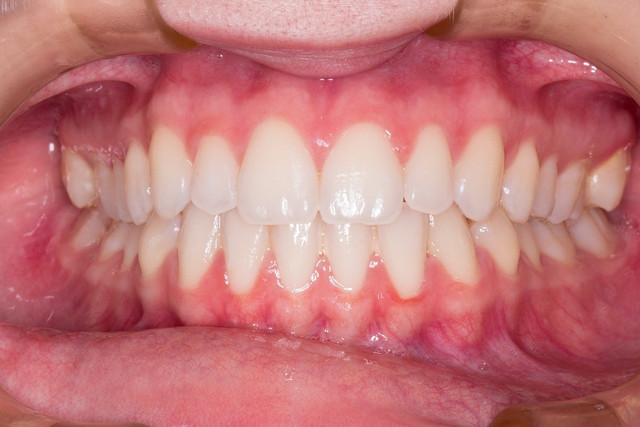 Wyszczerbianie zęba - jak przebiega proces?